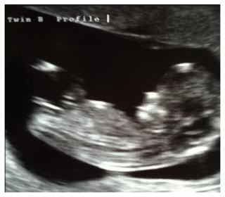 CONFIRMED GIRLS!!!! 12 week u/s with twins..boys or girls??? in